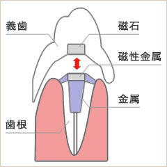 磁石式入れ歯の構造