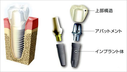 インプラント治療とは