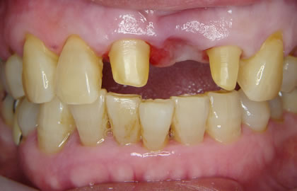 ブリッジで治療すると、欠損部の両隣の健全な歯を大量に削ってしまいます。