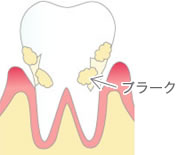 歯周病（歯槽膿漏）とは