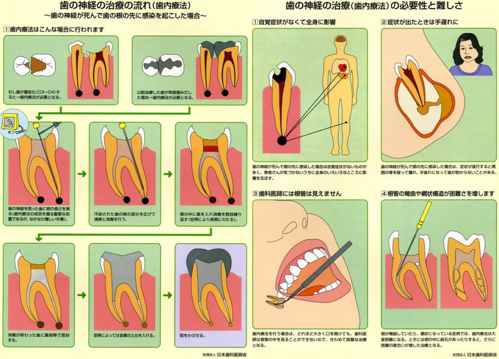 歯の神経の治療について