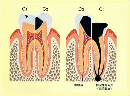 虫歯の進行度